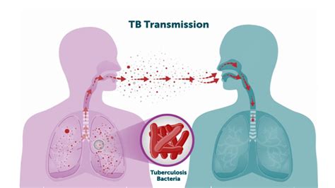 Tuberculosis: Causes and How It Spreads